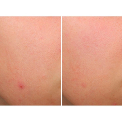 Bye Bye Brekout Serum 30 Ml